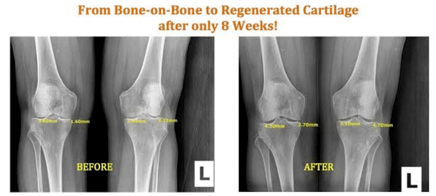 physiologic amount of fluid in knee