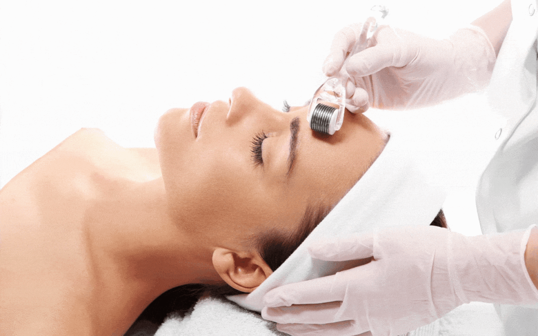Six Benefits of Microneedling + Why It’s a Must-Try!